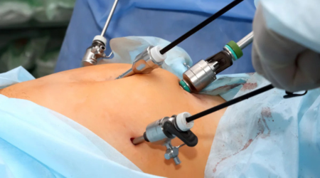 Laparoscopic Hysterectomy